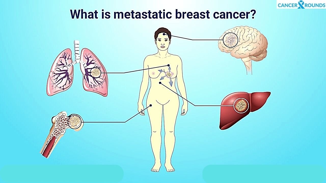 Metastasis of Breast Cancer to Other Organs 