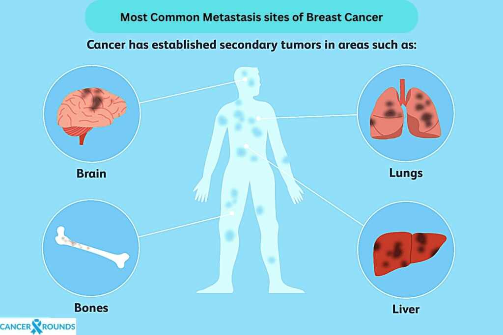 Most Common Metastasis of Breast Cancer