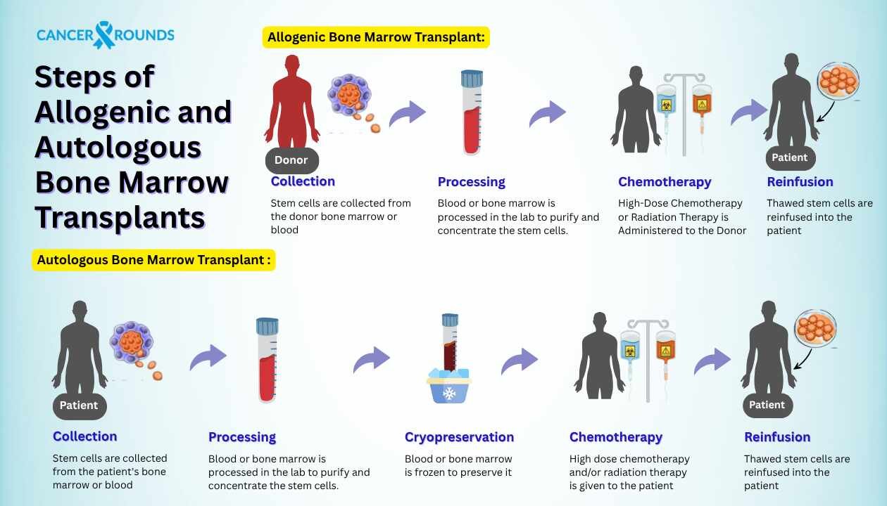 Steps of Allogenic and Autologous Bone Marrow Transplants