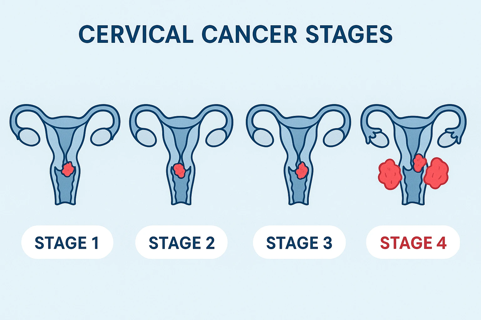Stage 4 Cervical Cancer Treatment – A Comprehensive Global Guide