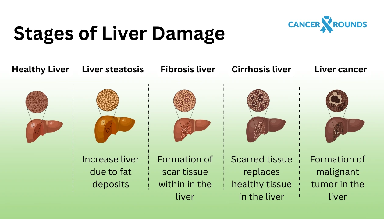 Liver cancer staging and classification