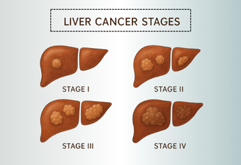 Treatment Approaches for Stage 4 Liver Cancer: A Global Perspective