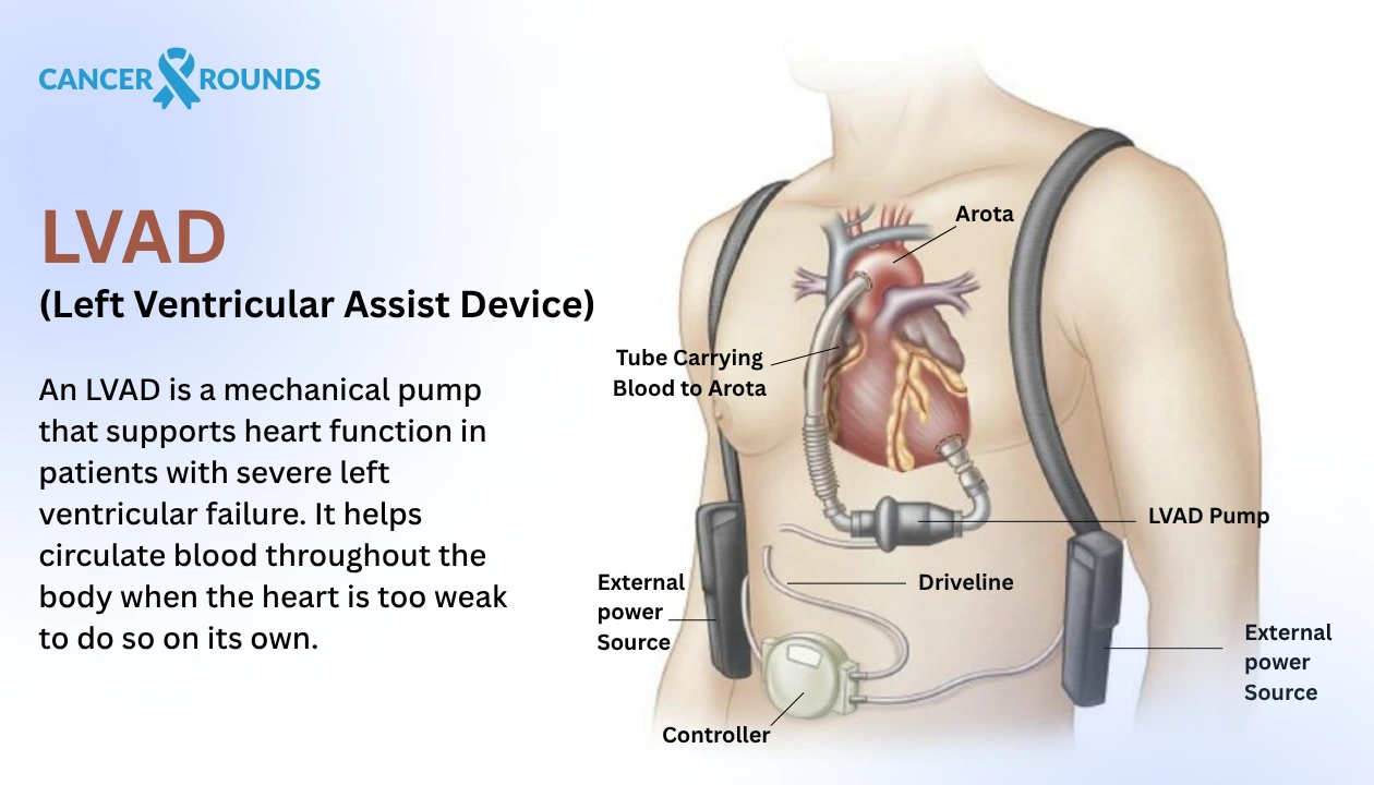 What is LVAD