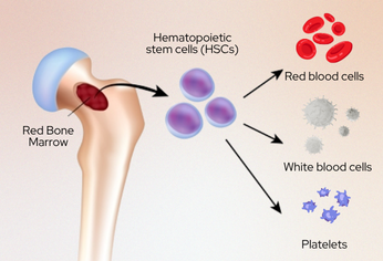 Bone Marrow Transplant for Sickle Cell Disease: A Guide to Cure and Hope