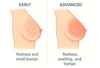 What Does an Early Inflammatory Breast Cancer Rash Look Like?