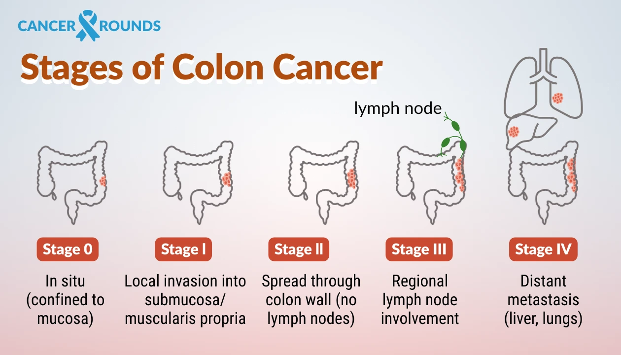 stages of colon cancer